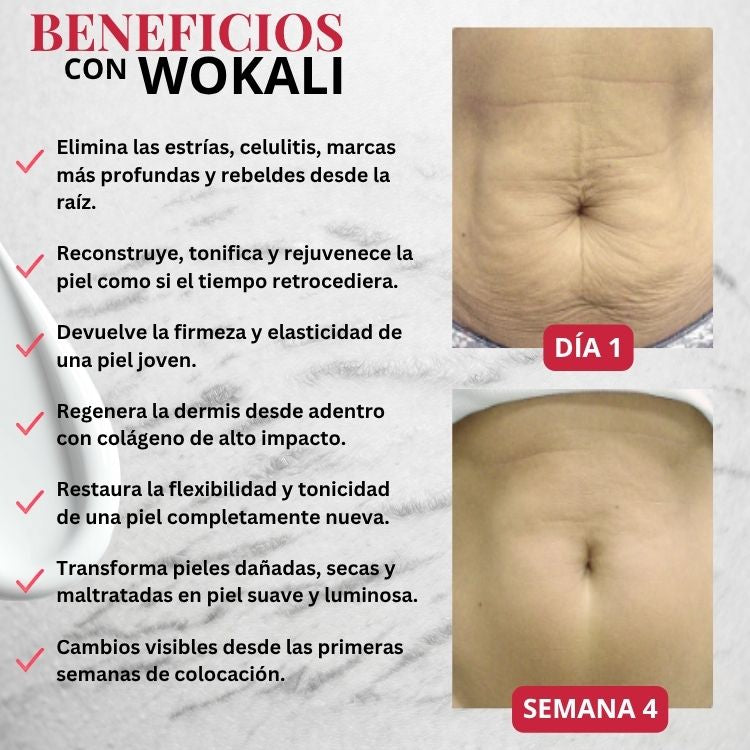 Wokali Dermacare™ - Tratamiento innovador para estrías de última tecnología.