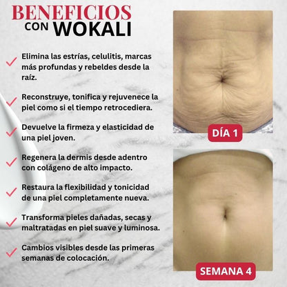 Wokali Dermacare™ - Tratamiento innovador para estrías de última tecnología.