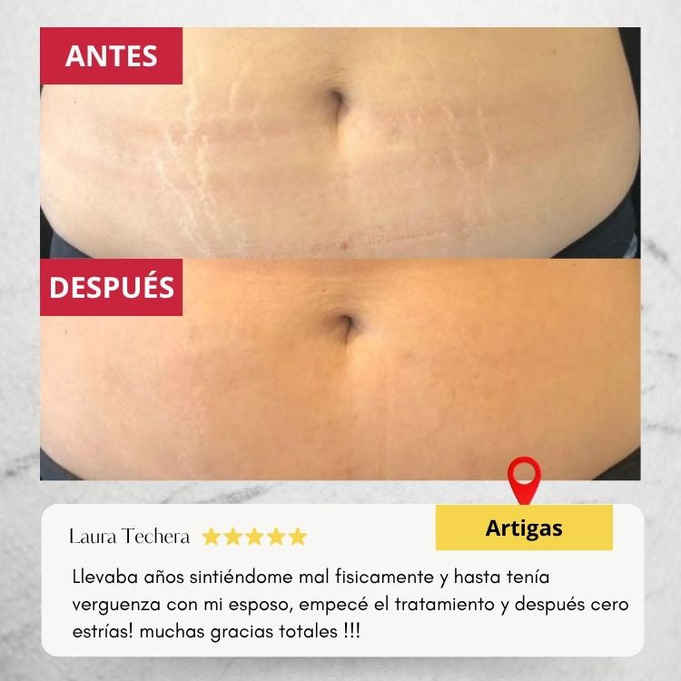 Wokali Dermacare™ - Tratamiento innovador para estrías de última tecnología.