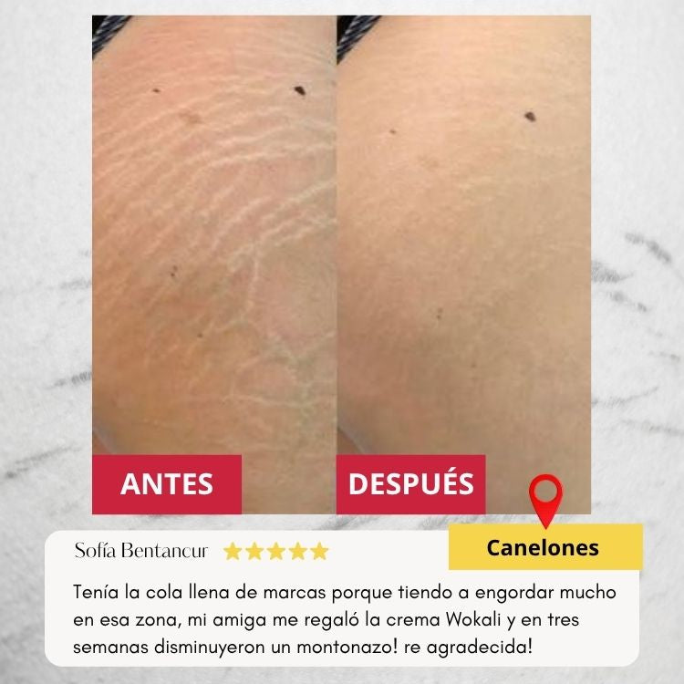 Wokali Dermacare™ - Tratamiento innovador para estrías de última tecnología.