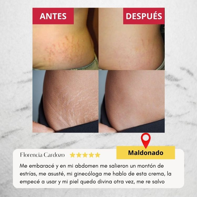 Wokali Dermacare™ - Tratamiento innovador para estrías de última tecnología.