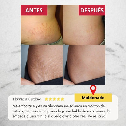 Wokali Dermacare™ - Tratamiento innovador para estrías de última tecnología.