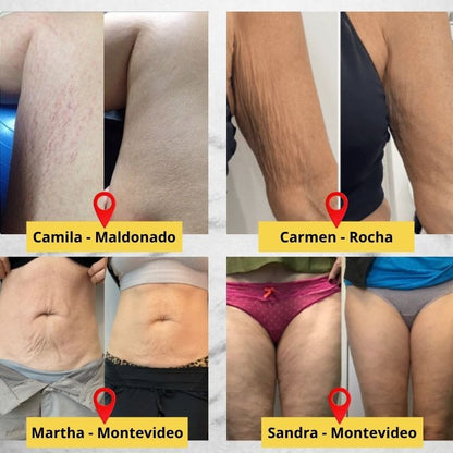 Wokali Dermacare™ - Tratamiento innovador para estrías de última tecnología.